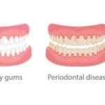 Receding Gums Pictures