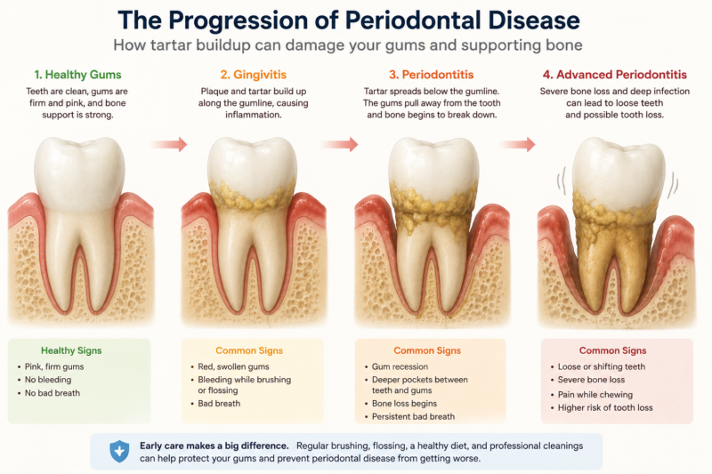 Advanced Periodontal Disease From Tartar