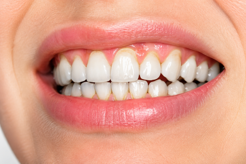 How to Remove Yellow Plaque From Teeth