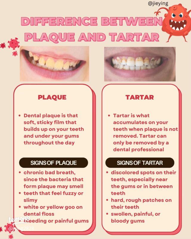 Plaque vs Tartar