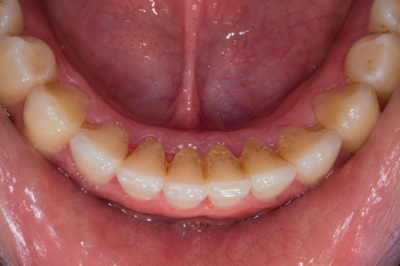 Best Toothbrushing Method for Plaque Control