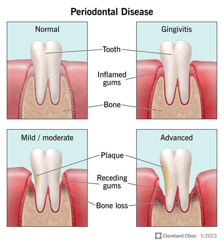 Advanced Gum Disease Treatment and Early Warning Signs