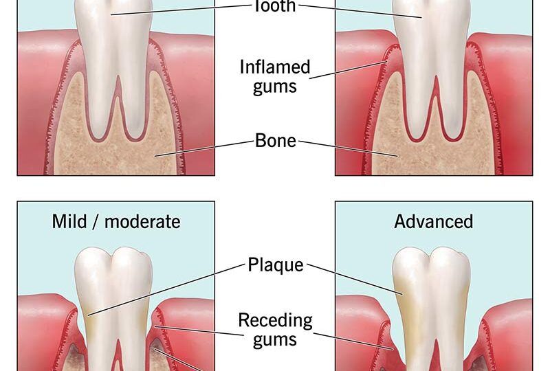 Advanced Gum Disease Treatment and Early Warning Signs