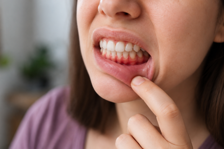 Bleeding Gums Causes and Prevention Guide