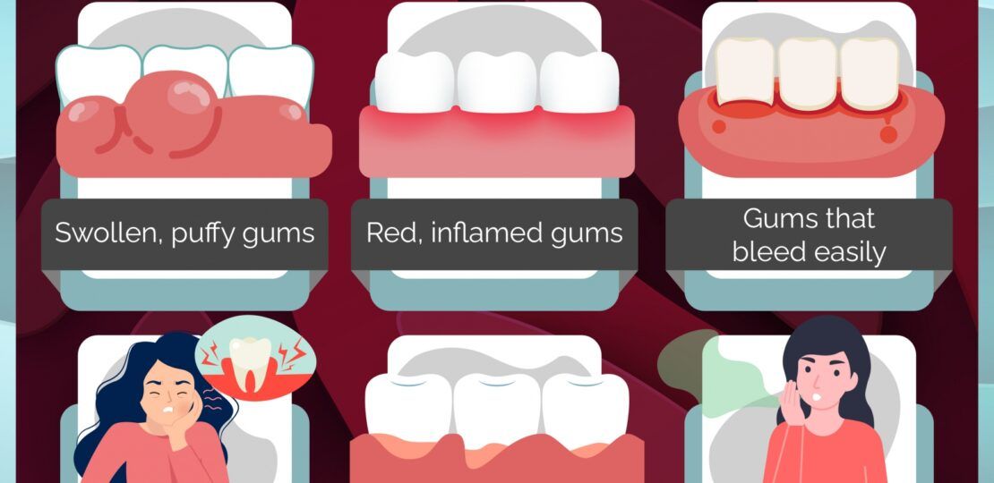 Bleeding Gums Treatment2