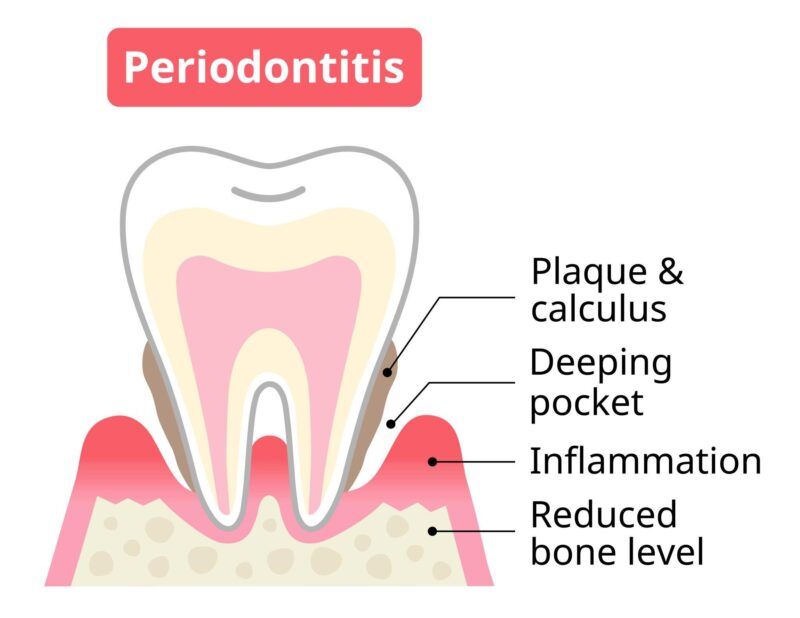 Deep Gum Pocket Causes and Prevention Guide
