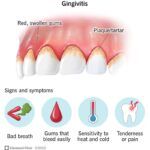 Gingivitis Treatment for Early Gum Recovery