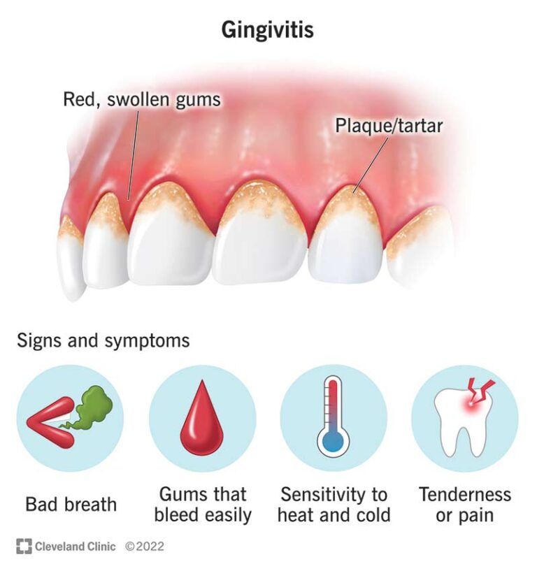 Gingivitis Treatment for Early Gum Recovery