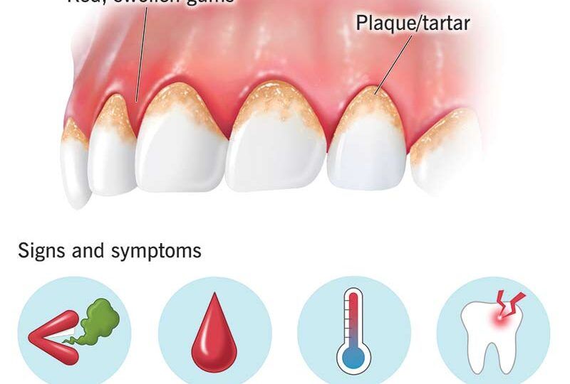 Gingivitis Treatment for Early Gum Recovery1
