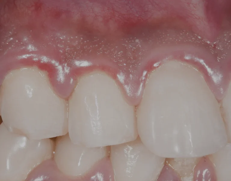 Gum Disease Early Signs You Must Not Ignore