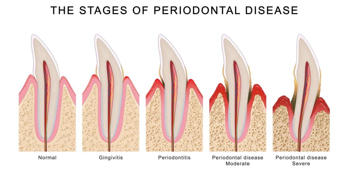 Gum Disease Stages and Early Treatment Guide1