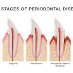 Gum Disease Stages and Early Treatment Guide