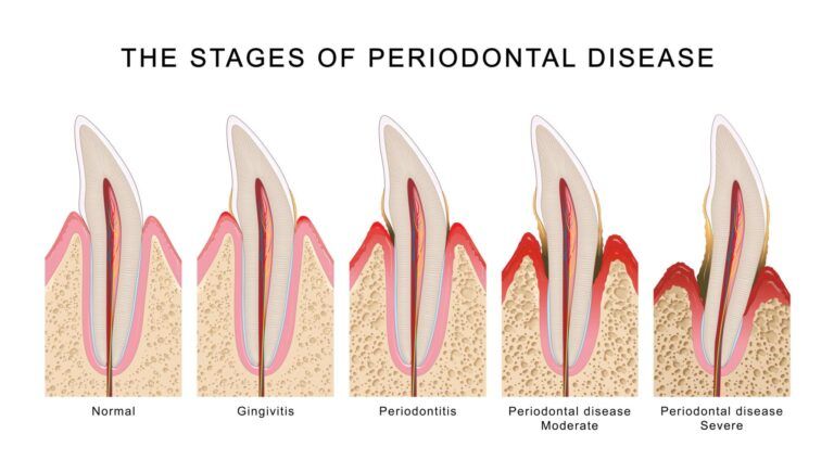 Gum Disease Stages and Early Treatment Guide