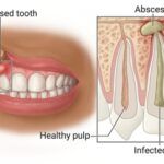 Gum Infection Treatment for Early Intervention