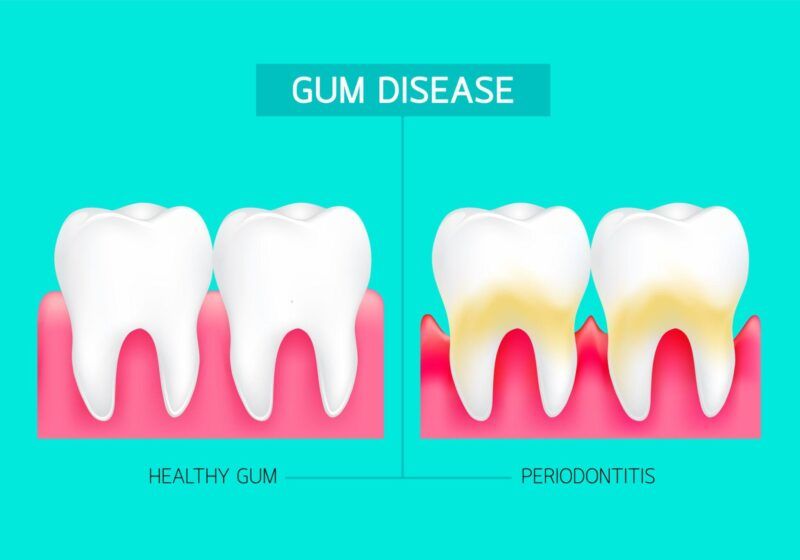 Gum Inflammation Treatment for Healthier Gums