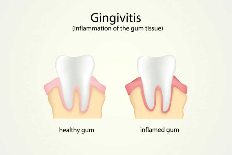 Gum pockets treatment