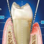 Gum pockets treatment