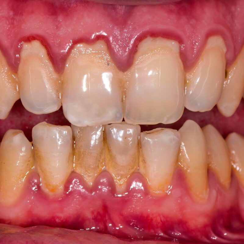 Gum Recession Prevention