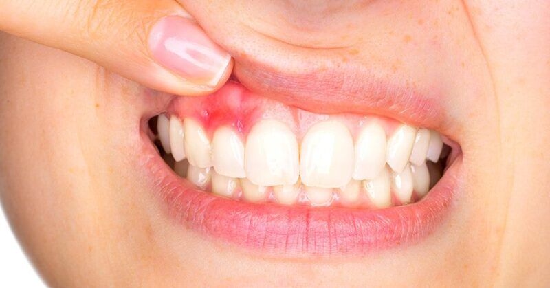 Gum Sensitivity Treatment