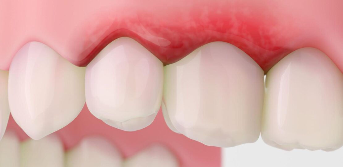 Inflamed Gums Treatment for Fast Gum Relief2