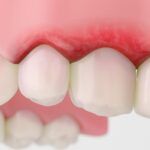 Inflamed Gums Treatment for Fast Gum Relief2