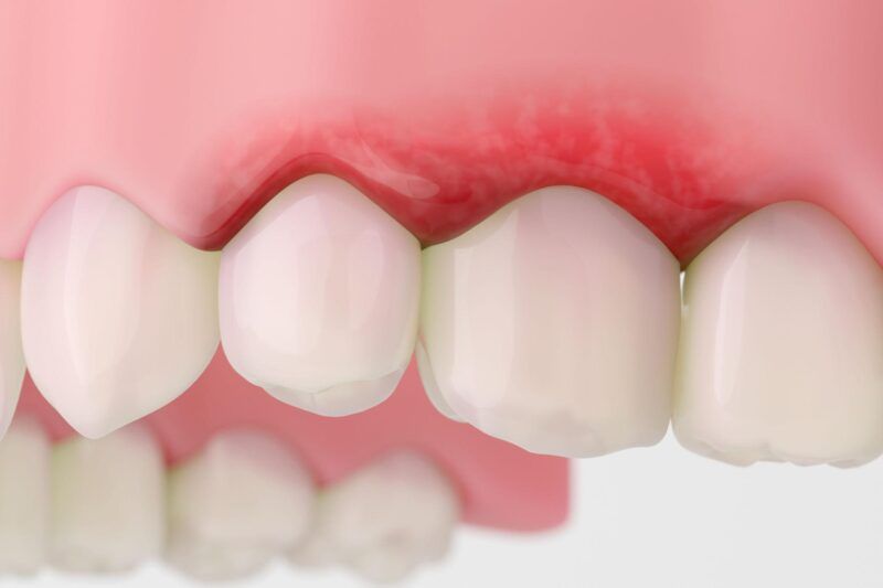 Inflamed Gums Treatment for Fast Gum Relief2
