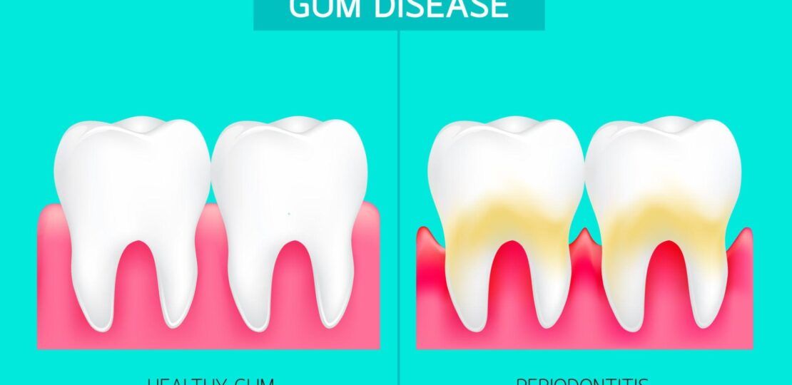Inflamed Gums Treatment1