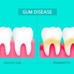 Inflamed Gums Treatment