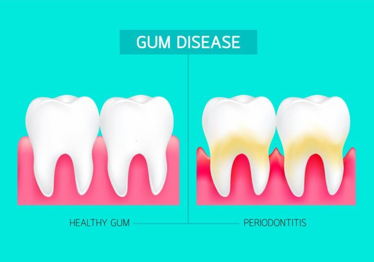Inflamed Gums Treatment