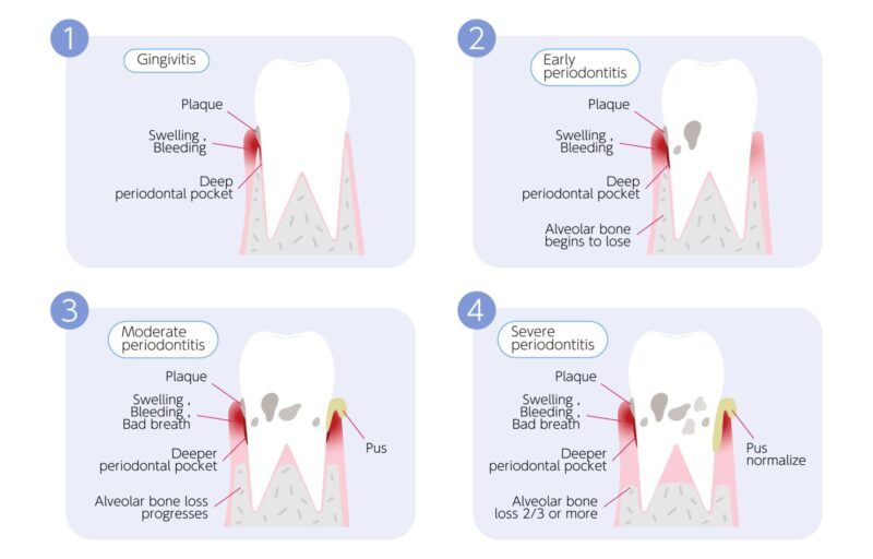 Periodontal Disease Prevention for Healthy Gums