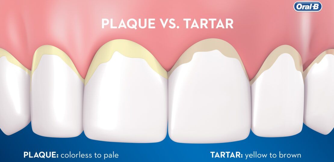 Plaque vs Tartar Buildup and Gum Health Risks