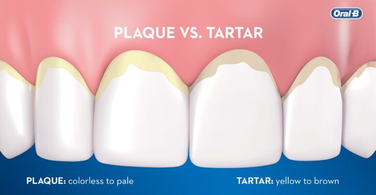 Plaque vs Tartar Buildup and Gum Health Risks