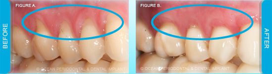 Receding Gums Treatment