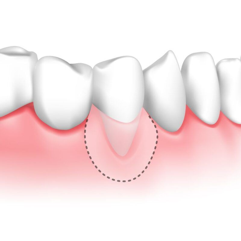 Receding Gums Treatment 