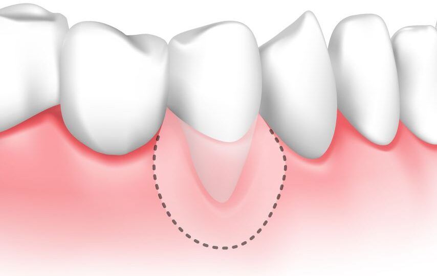 Receding Gums Treatment2