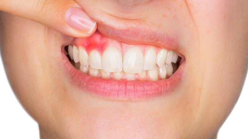 Sore Gums Treatment for Daily Gum Comfort