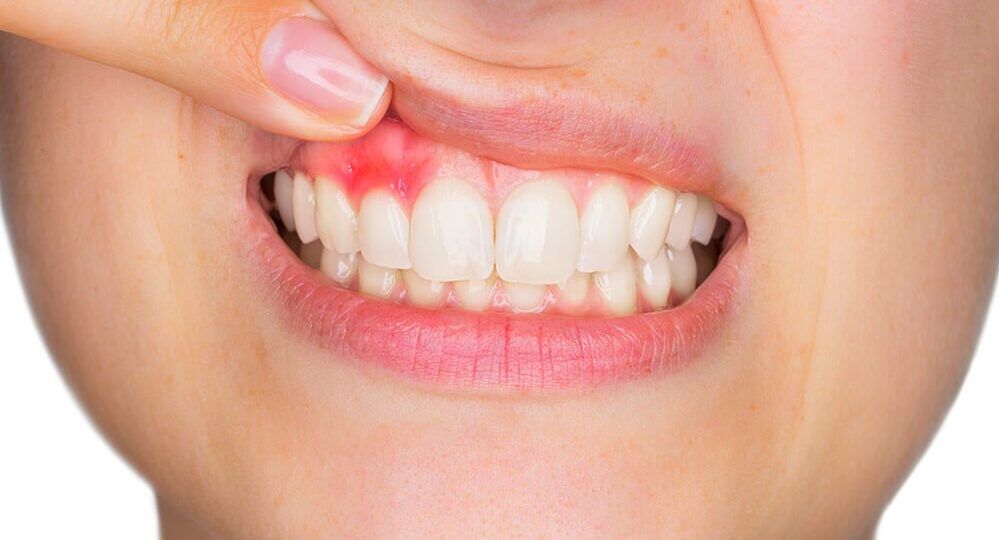 Sore Gums Treatment for Daily Gum Comfort