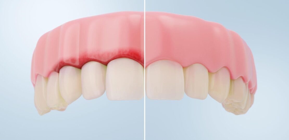 Swollen Gums Treatment for Early Gum Recovery1