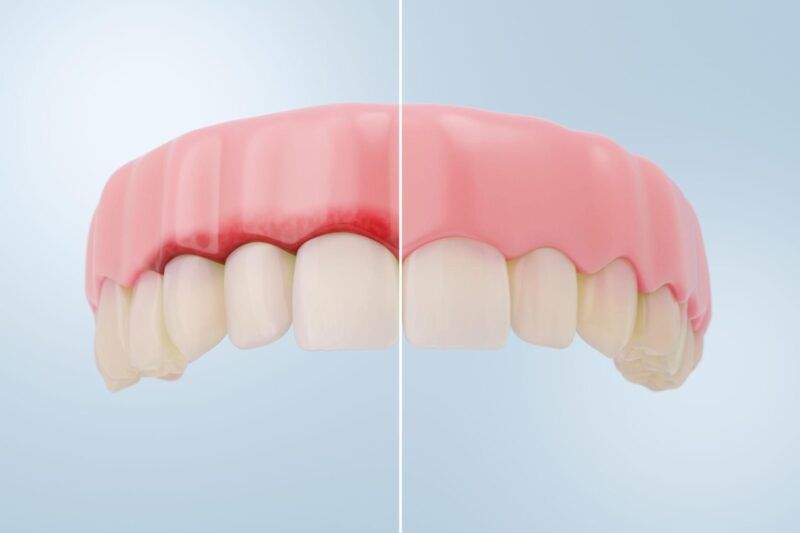 Swollen Gums Treatment for Early Gum Recovery