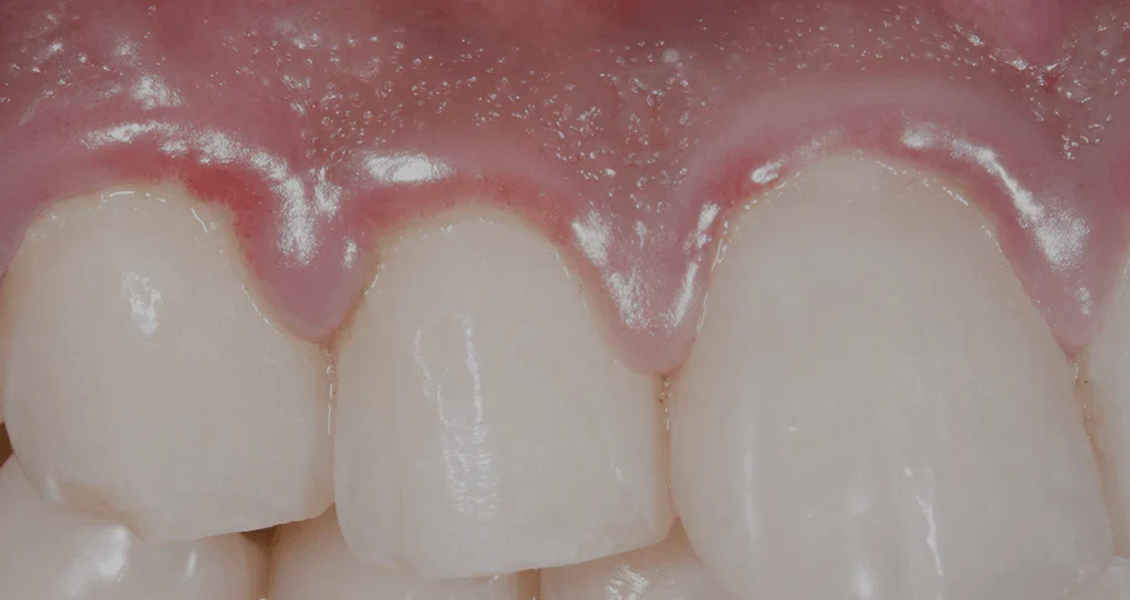 Swollen Gums Treatment for Healthier Gum Tissue1