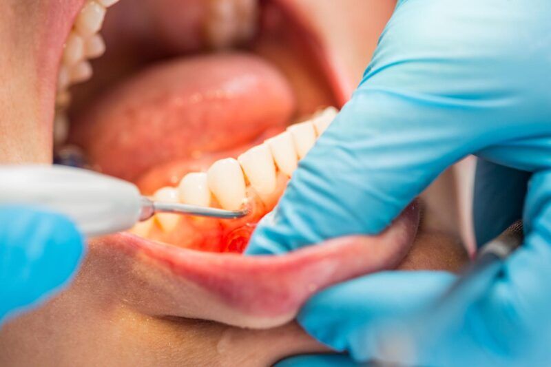 Tartar Buildup Prevention for Healthy Teeth