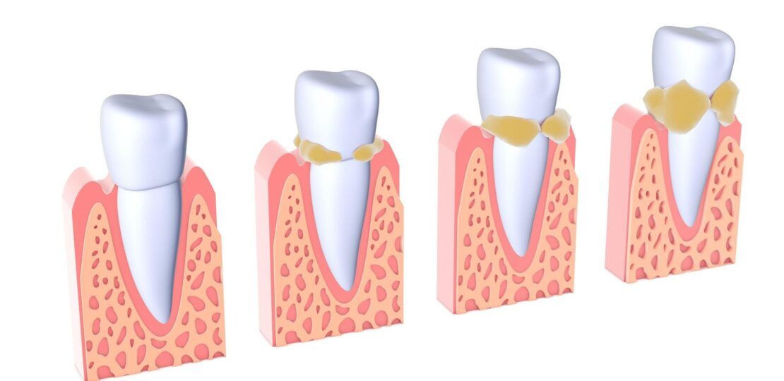 Tartar Buildup Prevention for Healthy Teeth1