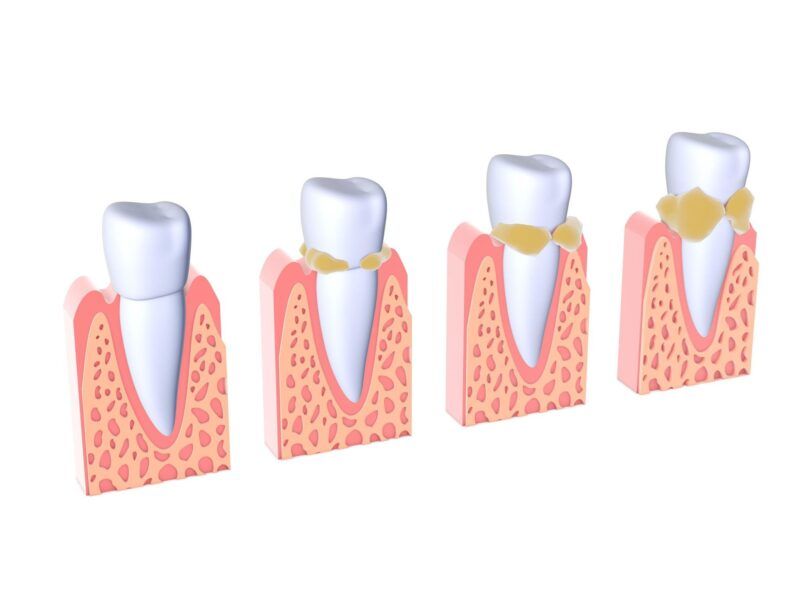 Tartar Buildup Prevention for Healthy Teeth