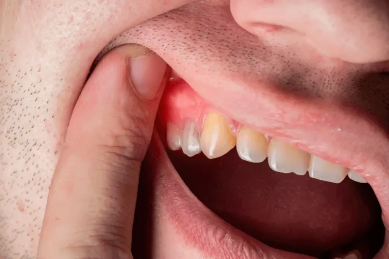 Tooth Root Exposure Treatment for Gum Protection